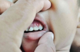 Kondisi ketika gigi anak mengalami 