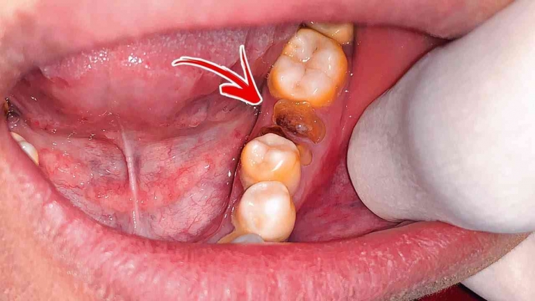 Pencabutan gigi sisa akar. (Sumber foto: Youtube dokter gigi tri putra _)