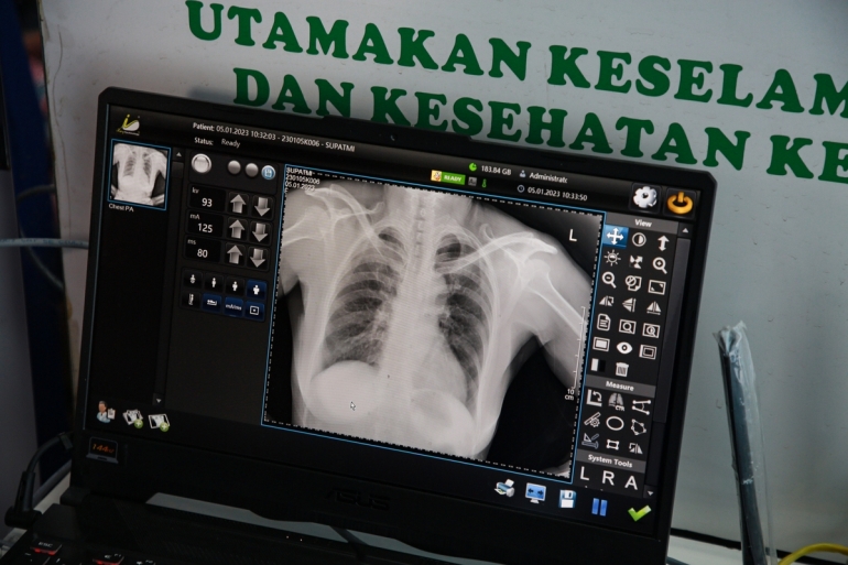 Hasil rontgen salah seorang warga dalam kegiatan Active Case Finding TBC di Kantor Kecamatan Larangan, Kota Tangerang, Banten, Kamis (5/1/2023). Foto: KOMPAS/PRIYOMBODO