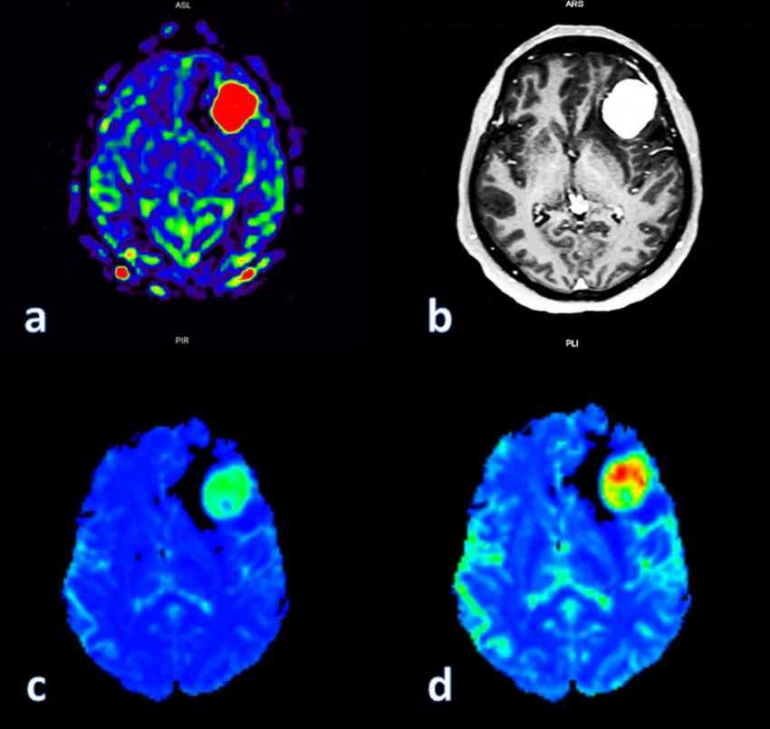 MRI Perfusi Meningioma (sumber: Thomas Theofanis, Malia
