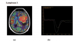 MRI Perfusi DSC (a) relative Cerebral Blood Volume (rCBV) (b) Grafik kuantitatif analisis perfusi pada tumor (sumber: https://unair.ac.id)