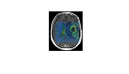 MRI Perfusi DCE premiability K-trans pada kasus tumor (sumber: https://unair.ac.id)