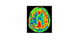 MRI Perfusi ASL Cerebral Blood Flow (CBF) pada kasus tumor (sumber: https://unair.ac.id)
