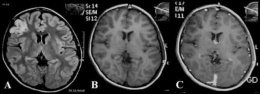 Gambar MRI Brain Axial FLAIR (A), T1 pre contrast (B) dan T1 post contrast  (C) menunjukkan penebalan kortikal fokus pada lobus frontalis