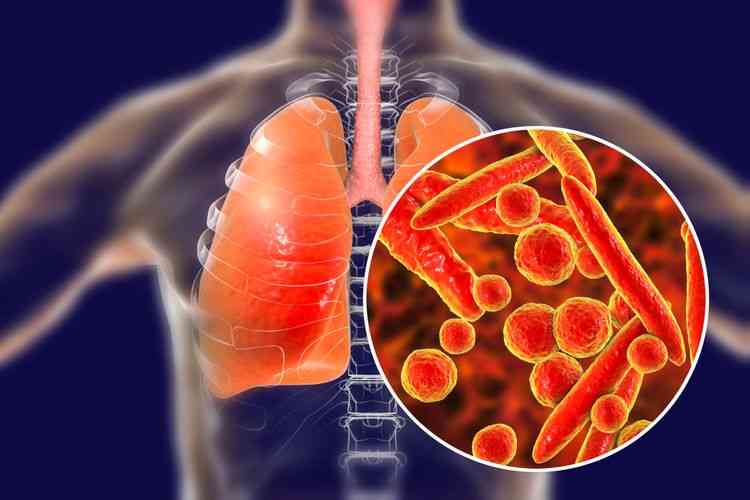 Ilustrasi Mycoplasma Pneumonia di dalam tubuh manusia. (Sumber: Shutterstock/Kateryna Kon via kompas.com) 