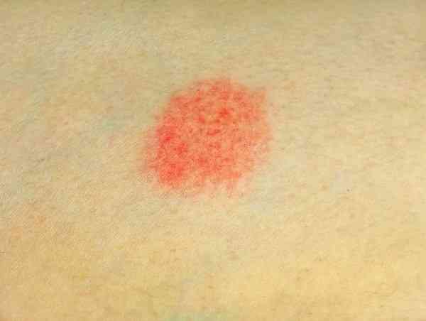Ruam merah pada kulit (Sumber: alodokter.com)
