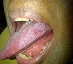 Oral Hairy Leukoplakia; Sumber Foto : Jurnal Unair