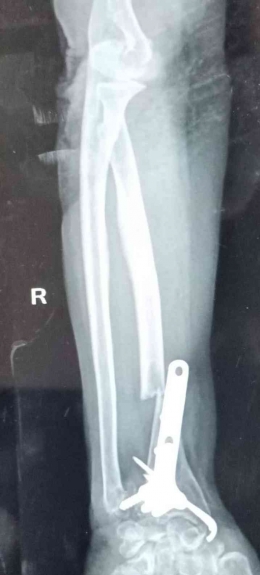 Patah Tulang Lengan Ibuku, yang harus operasi. dokpri