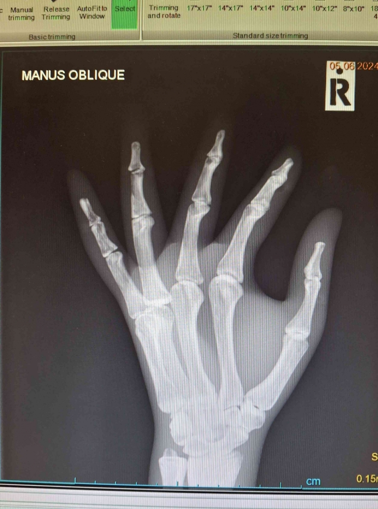 Teknik Pemeriksaan Radiografi Manus Bone dengan Indikasi Fraktur ...