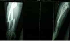 Pemeriksaan Antebrachii AP dan Lateral pada Kasus Fraktur Antebrachii ...