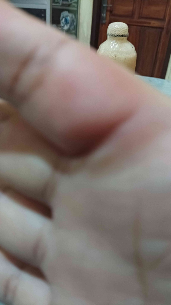 Jari memerah dan melepuh terkena tutup botol yang terlempar karena ledakan (Dokumentasi pribadi: Isti Yogiswandani)