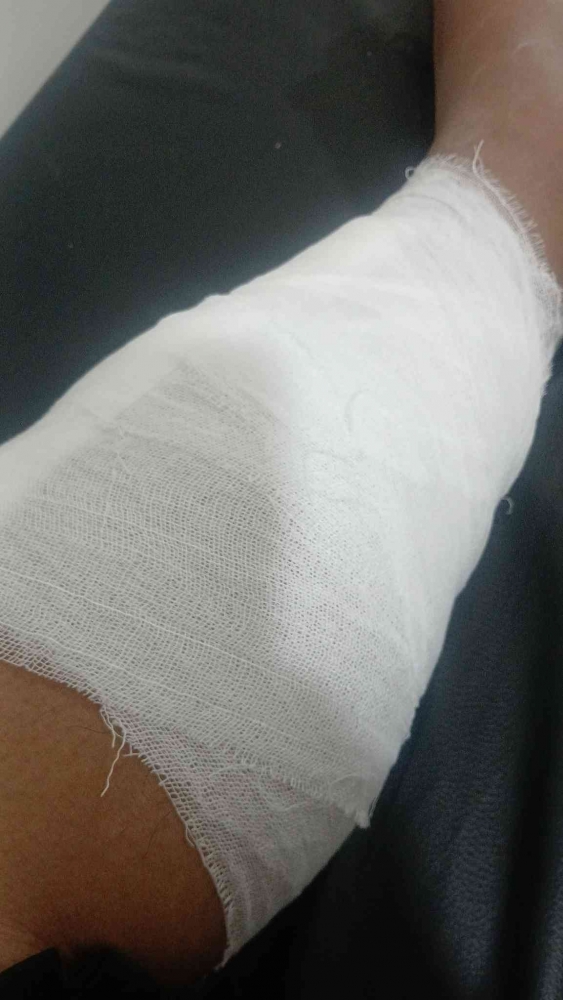 Luka Diabetes di Kaki Kiri Omjay/dokpri