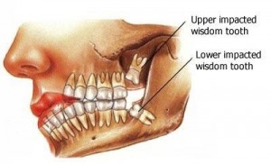 Cara mencabut gigi geraham sendiri tanpa rasa sakit