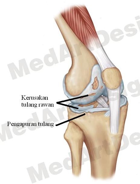 Артроз коленного сустава мениск