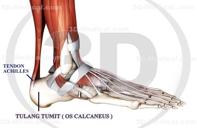 Sakit Tumit Asam Urat atau Bukan oleh Kosasi Kwek Sakit Tumit Asam Urat atau Bukan oleh Kosasi Kwek