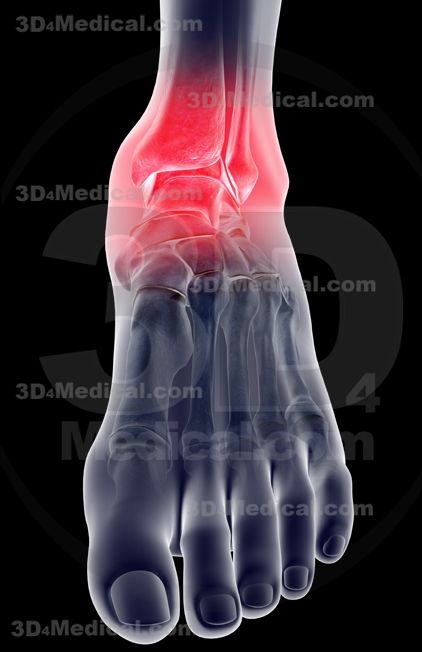 Sakit Tumit Asam Urat Atau Bukan Halaman 1 Kompasiana Com