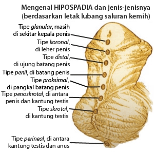 hipospadias penis)