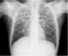 Flek Paru Tb Or Not Tb Kompasiana Com