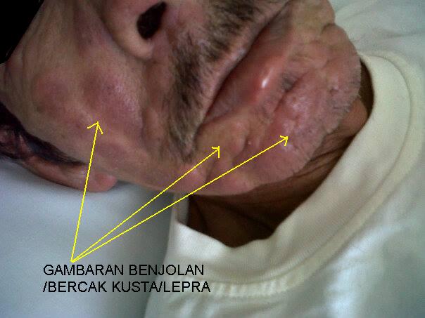 Terpaksa Konsultasi Pribadi Ke Dokter Spesialis Kulit Dan Kelamin Halaman All Kompasiana Com