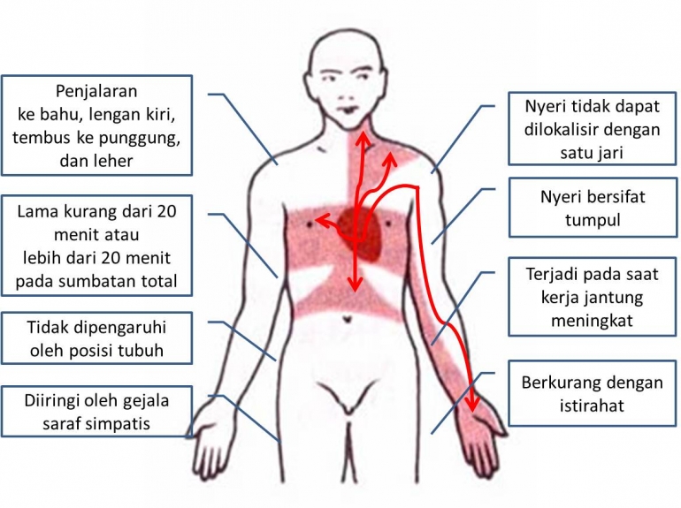 Ini Ciri Khas Nyeri Dada Karena Jantung Kompasiana Com