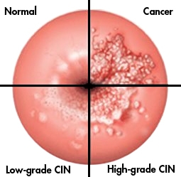 Kanker mulut rahim (Low Grade CIN dan High Grade Cin merupakan Lesi Prakanker.) (Diambil dari : http://1.bp.blogspot.com/_RDPYylESfZE/TMMs9xfjKFI/AAAAAAAAAuI/mS_kCa5uzTo/s1600/Cervical-Cancer.jpg)