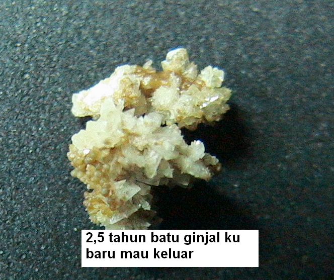Batu Ginjalku Keluar Tanpa Harus Operasi Kompasiana Com