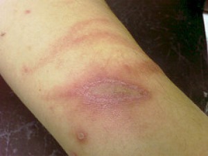 Tomcat atau Paederus sp.: Apa dan Bagaimana Pengobatannya - Kompasiana.com