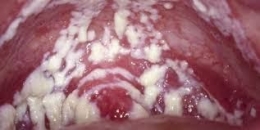 Salah satu varian keputihan gatal dan bergumpal..erat hubungannya dengan infeksi jamur. (Diambil dari : http://4.bp.blogspot.com/-vCtIEH7MNXI/Us5-kfXR-KI/AAAAAAAAAt0/LtzsSzCgrHs/s1600/images+(1).jpg)