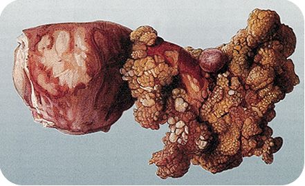Kanker indung telur (struktur berbenjol-benjol di sebelah kanan)