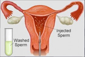 Proses Inseminasi intrauteri