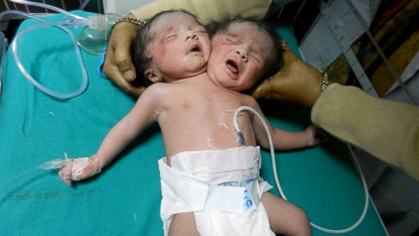 Seorang perawat sedang menjaga bayi perempuan berkepala dua yang lahir di sebuah rumah sakit di Sonipat, India, 13 Maret 2014. (Photo: Sanjeev Ghangas/Cover Asia Press)